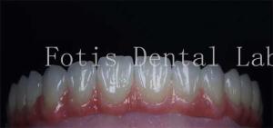 Quality Smooth Surface Cosmetic Tooth Coverings Natural Porcelain Veneers Customizable wholesale