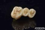 High Biocompatibility Zirconia Full Contour Crown Perfect Fit High Strength