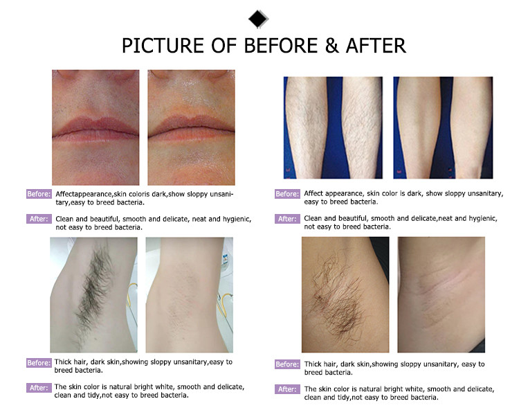 china newest best verticle painfree big spot 3 wavelength smooth skin ce permanent hair removal 755 808 1064 1200w diode