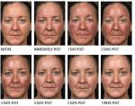 Beauty Salon Co2 Laser Skin Resurfacing , Fractional Skin Resurfacing 600W