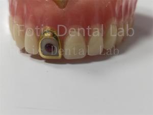 Quality Comfortable Full Acrylic Denture For Professionals Stain / Odor Resistant wholesale