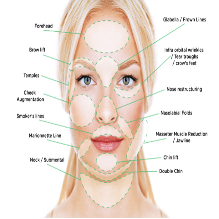 best-selling ultra v top quality pdo 3d cog facial lift threads