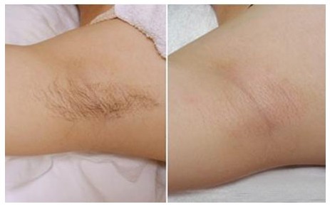 Lightsheer Diode Laser Hair Removal Equipment Professional , Adjustable Pulse Width