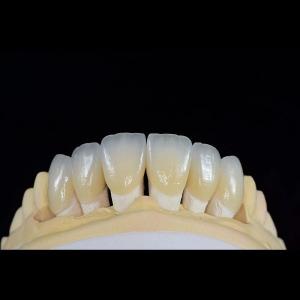 Quality Feldspathic Porcelain Dental Veneer Layered Zirconia Fabrication wholesale