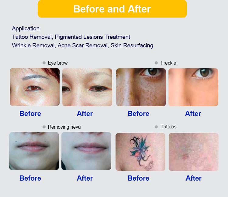 Nd Yag Picosecond Q Switched Nd Yag Laser 2025 Picosecond Laser Tattoo Removal Beauty Machine Laser Picosecond