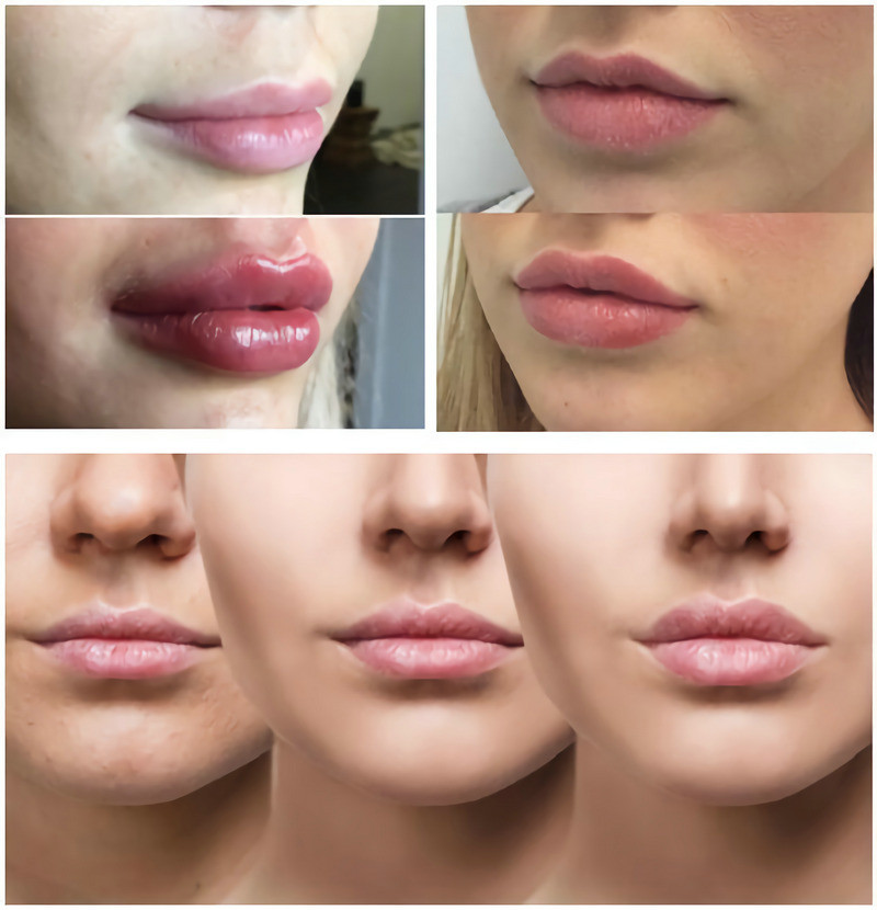 5ml Lip Filler Hyaluronic Acid Injection Gel Filler Bottle Syringe Package Facial Wrinkles Treatments
