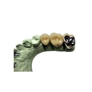 Quality High Biocompatibility PFM Crown Porcelain Fused For Back Teeth Restoration wholesale