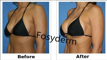 Personal Care 10ml Hyaluronic Acid Breast Filler To Increase Breast Size