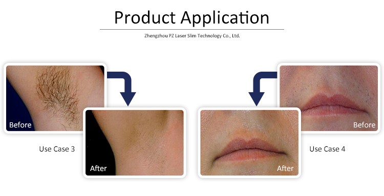 Safety No Pain Mobile Diode Laser Hair Removal Machine For Beauty Salons