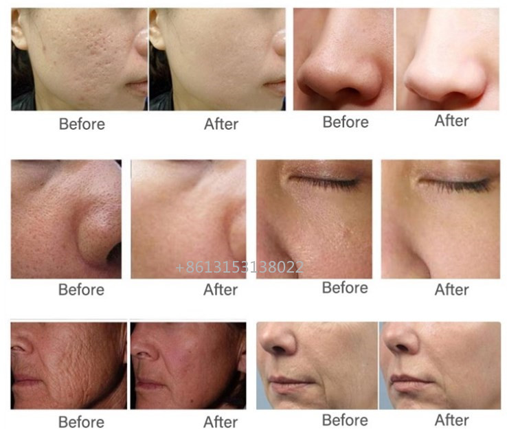 Hyamely PDRN Salmon Skin Regeneration Injection