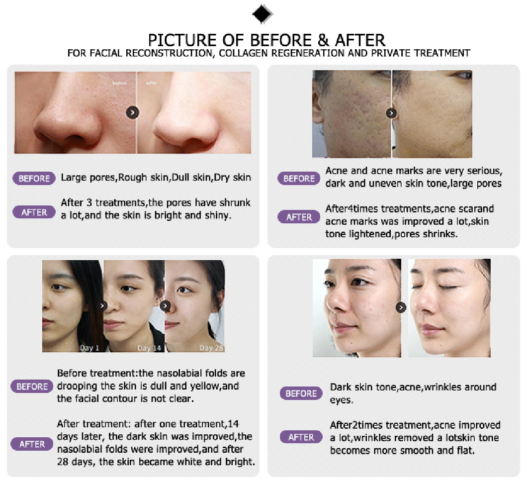 China factory direct sales carbon dioxide skin resurfacing fractional laser for stretch marks