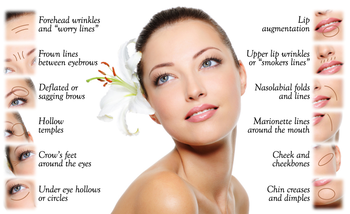 Fosyderm Hyaluronic Acid Forehead Wrinkles 1ml 2ml Injectable Filler Type