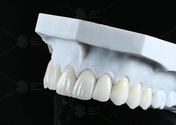 Translucency CAD EMAX Veneer Polished Glazed Ceramic Restorations For Anterior