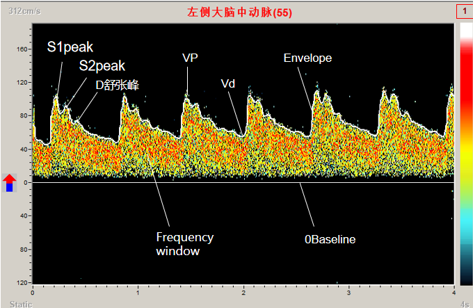 Four-depth Ultrasound Transcranial Doppler blood vessels analysis TCD system