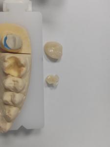 Quality Long Lasting Restorations Dental Inlay Onlay Superior Strength And Durability wholesale