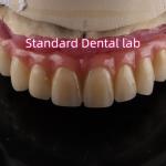 Zirconia Implant Bridge Screw Retained With Pink Gum Porcelain