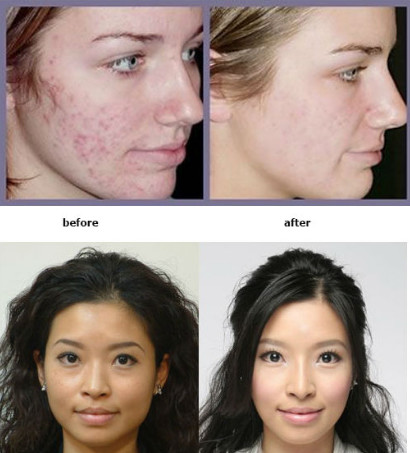 OEM Water Oxygen Jet Peel Oxygen , Skin Rejuvenation Machine For Facial Peeling