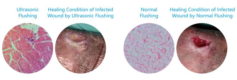Factory price for the Wound debridement system ultrasonic wound debridement machine