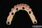 Durable Dental Aesthetic Titanium Malong Hybrid Bridge For Care