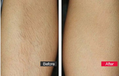 Lightsheer Diode Laser Hair Removal Equipment Professional , Adjustable Pulse Width