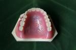 ISO13485 Conventional Denture Upper Acrylic Partial