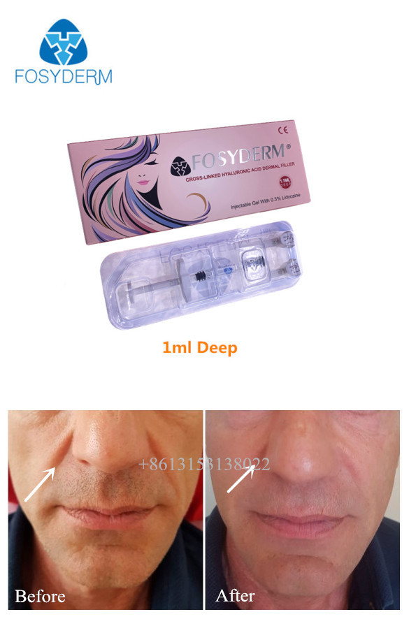 1ml 2ml cosmetic dermal filler For Deep Wrinkles HA Gel Injection CE