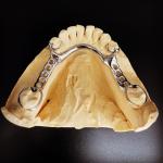 Fast and Cast Framework Co-Cr Metal Partial Denture Framework for Dental