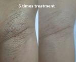 4 Wavelengths Diode Laser Hair Removal Machine 808nm/755 808nm 1064nm with User