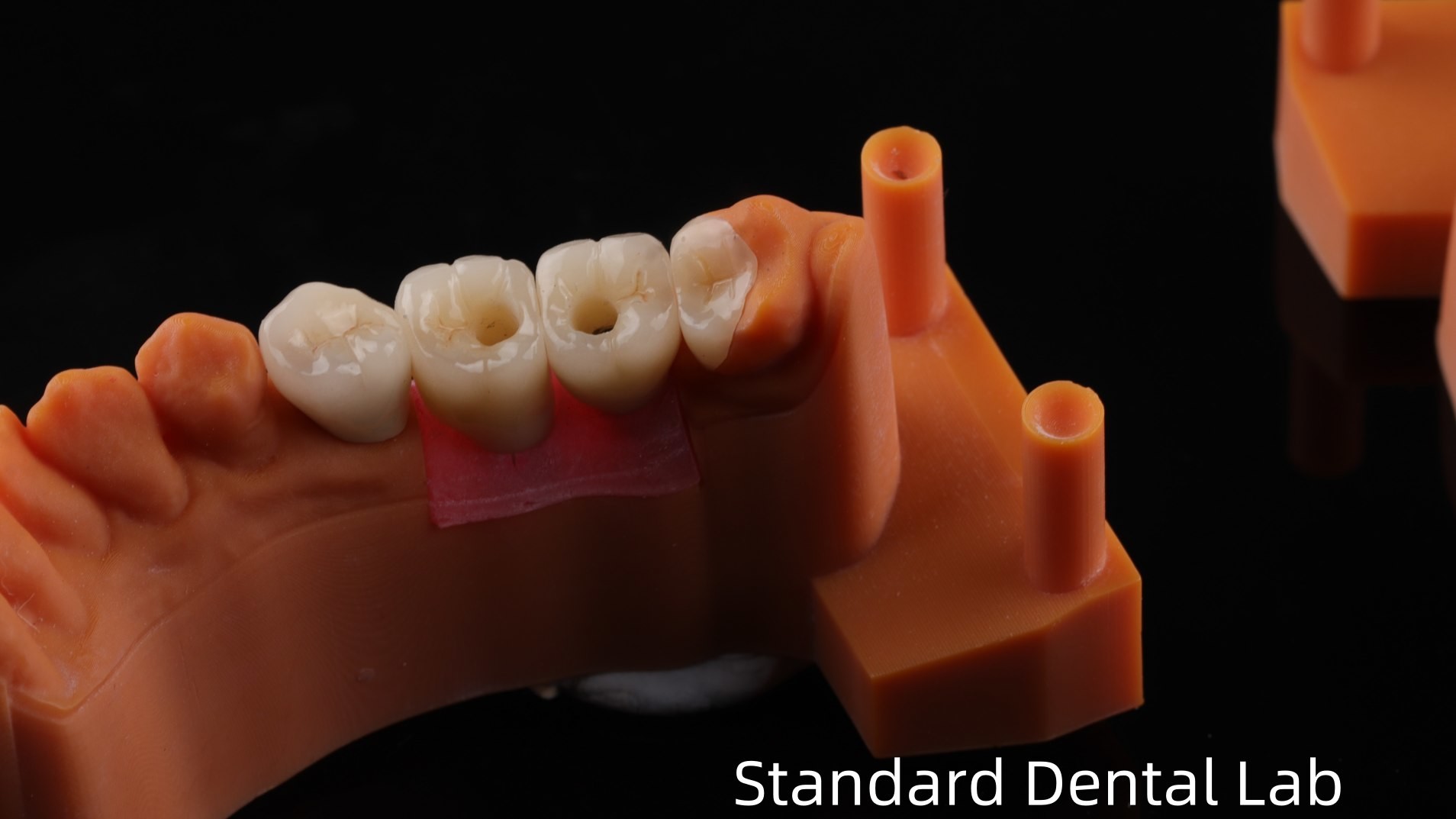 Screw Retained Dental Implant Crown with PFZ Porcelain Layered Zirconia 5-Year Gurantee and 3D Print Model
