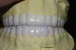 Temporary PFM Dental Crown
