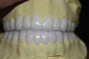 Quality Temporary PFM Dental Crown wholesale