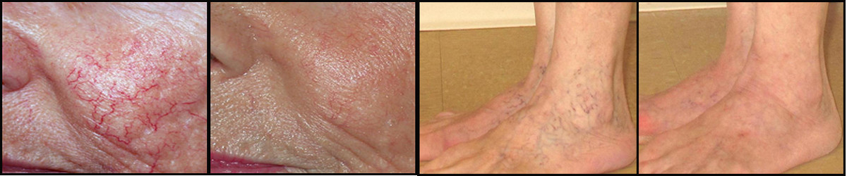 Laser treatment for varicose veins Best treatment for varicose and spider veins