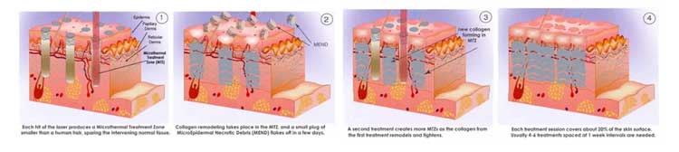 Safe 1550 Er Yag Laser Lifotronic Fractional Erbium Glass Laser for Skin Resurfacing