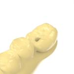 Temporary Crown Biocompatible Resin Dental Bridge Photosensitive Resin