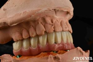 Quality Low Density Titanium Malong Hybrid Bridge Dental Light Weight Comfortable Wear wholesale