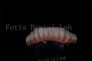 Quality Full Mouth Restoration All On 4 And All On 6 Titanium Or Zirconia Highly Success Rate wholesale