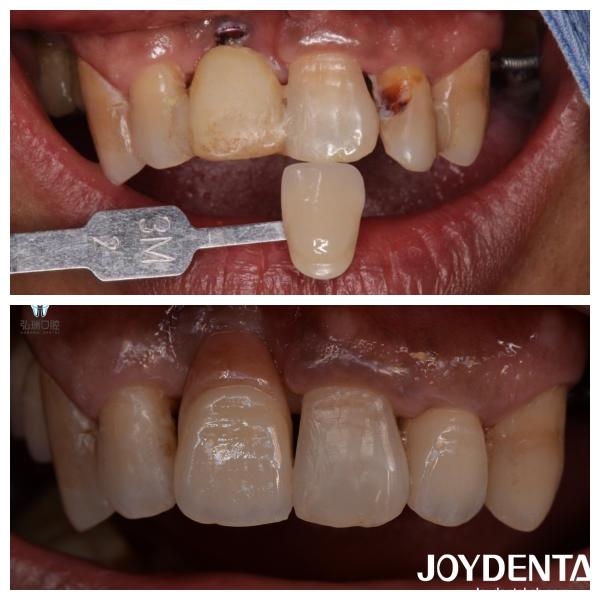 Customized Dental Zirconia Veneers Natural Color Lifelike Restorations Tooth