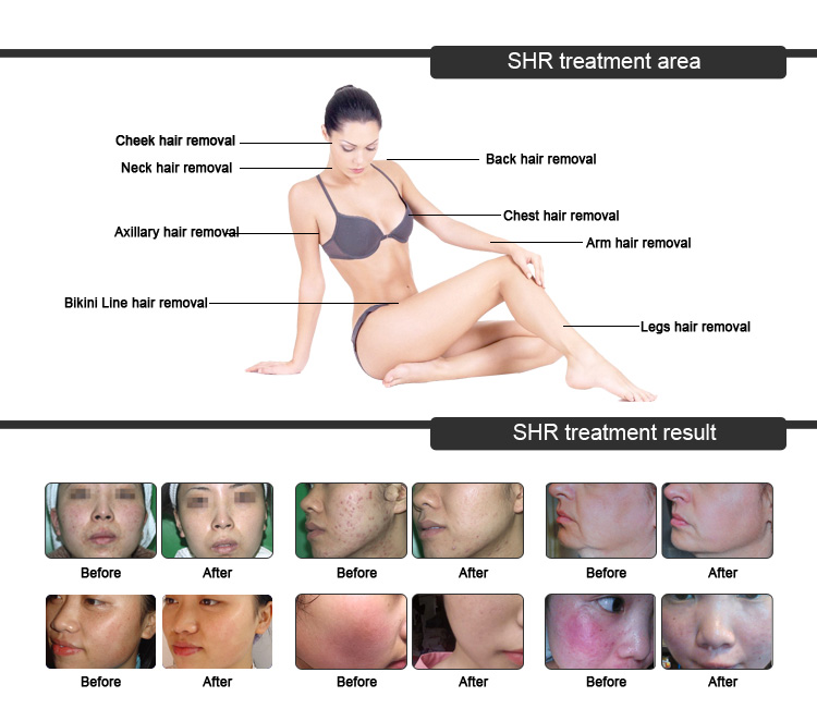 Home OPT IPL Laser Machine Permanent Skin Whitening Laser Treatment Machine