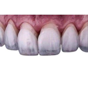 Quality Dental Lab Dental Veneers Dentures Restorative Zirconia Crown Veneers wholesale