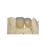 Smooth Surface PFM Metal-Ceramic Crown Corrosion Resistant