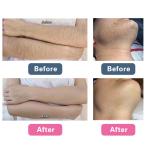 Commercial Q Switched Laser Tattoo Removal Machine 1064nm 532nm 755nm