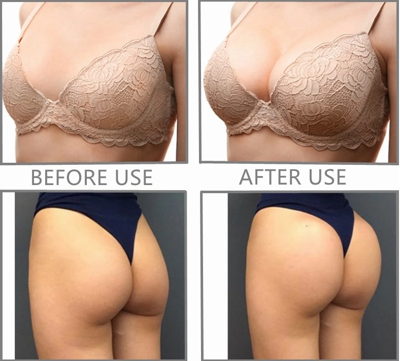 Acido hialuronico gel Hip Buttock Increase Dermal Filler Breast Pump Big Butt Enlargement Injection