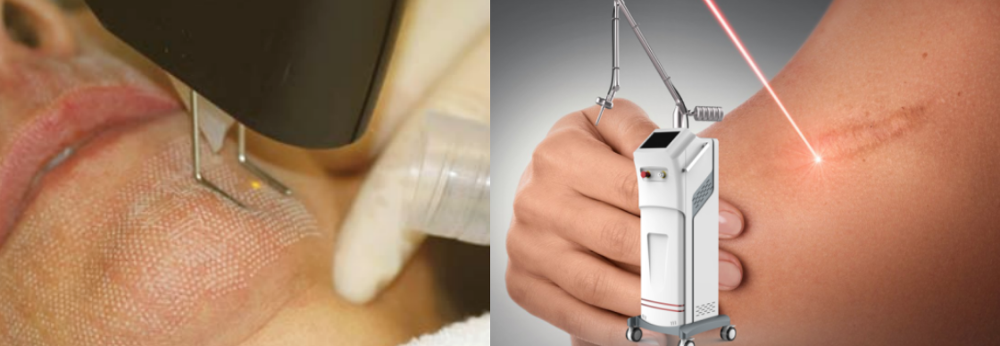 10600NM 40W RF CO2 Fractional Laser Machine Vaginal Tightening High Performance