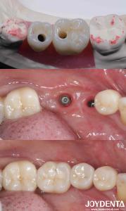 Quality Cylindrical All On 4 Titanium Dental Implants 10-16mm Length Hex Connection wholesale