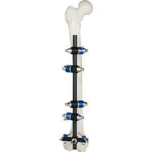 Quality Femur Tibial External Fixator wholesale