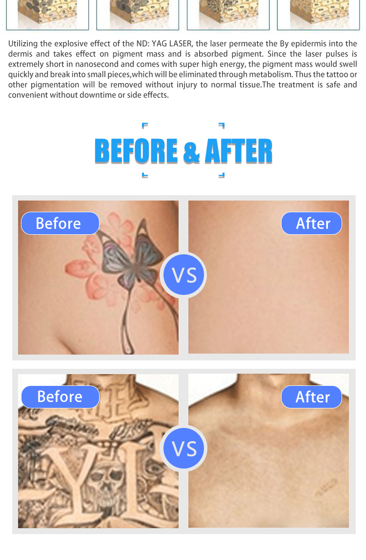 Professional Tattoo Removal Laser Beauty Instrument with Water Cooling Air Cooling