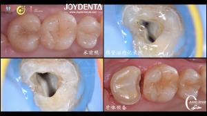 Quality Long Lasting Natural Looking dental ceramic inlay Precise Fit High Compatibility wholesale