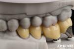 Natural-looking Implant Crown And Bridge Safe For Oral Long Lasting Performance