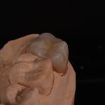 Full Contour Translucent Zirconia Crown for Aesthetically Pleasing Results