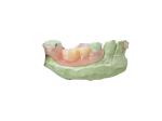 Invisible Denture Base Resin For Fast Production And Partially Edentulous